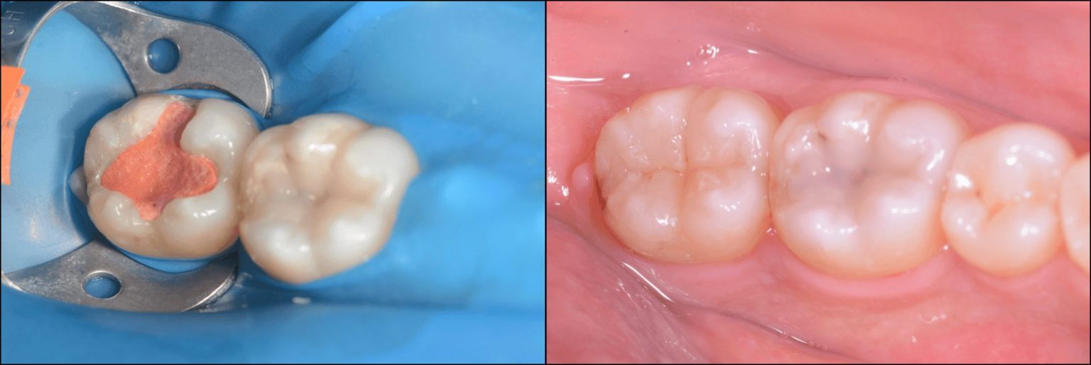 【もう一度学ぼう】歯牙それぞれの解剖学的特徴：下顎大臼歯編